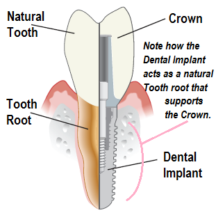 Traditional Implant