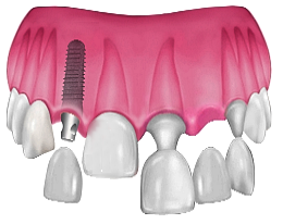 Traditional Implant